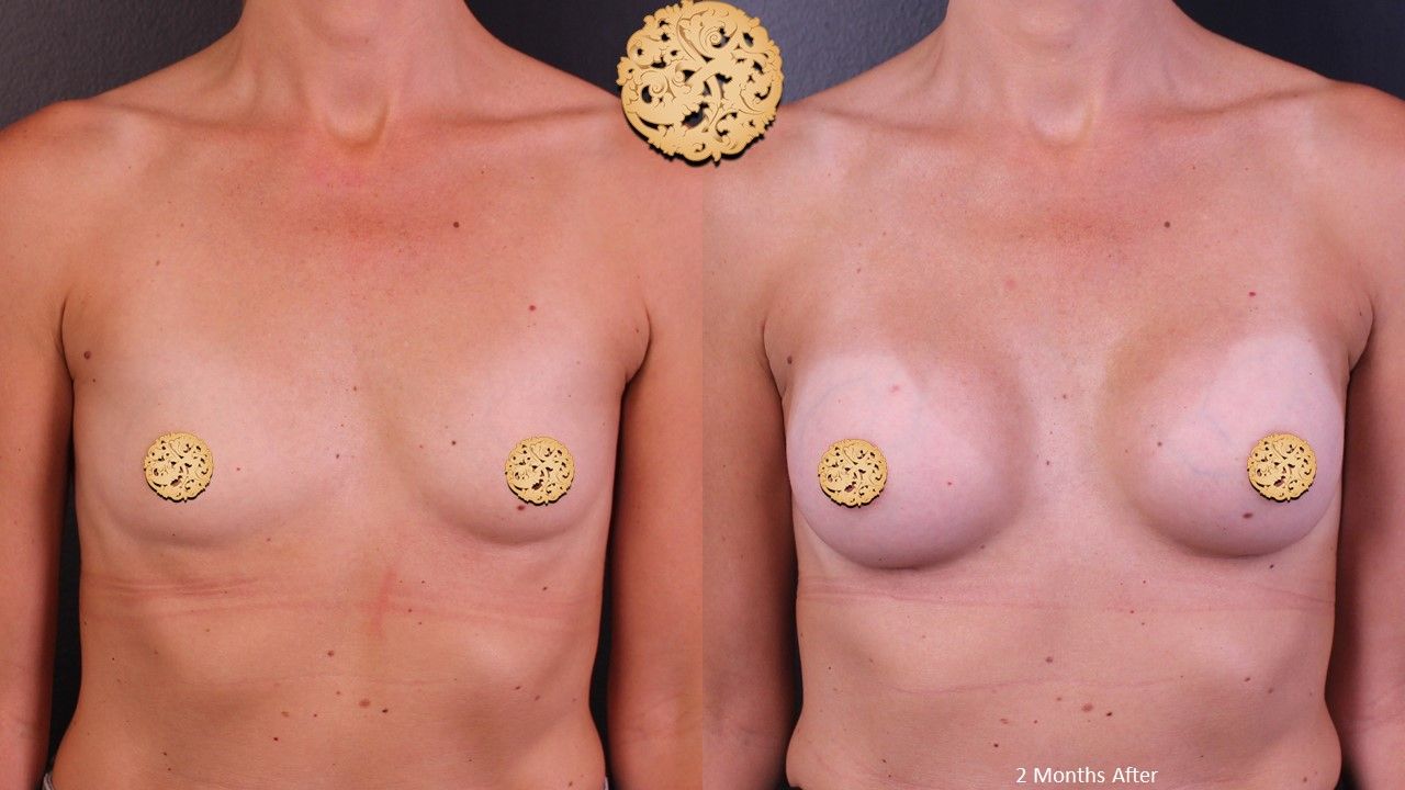 Breast Augmentation Before & After