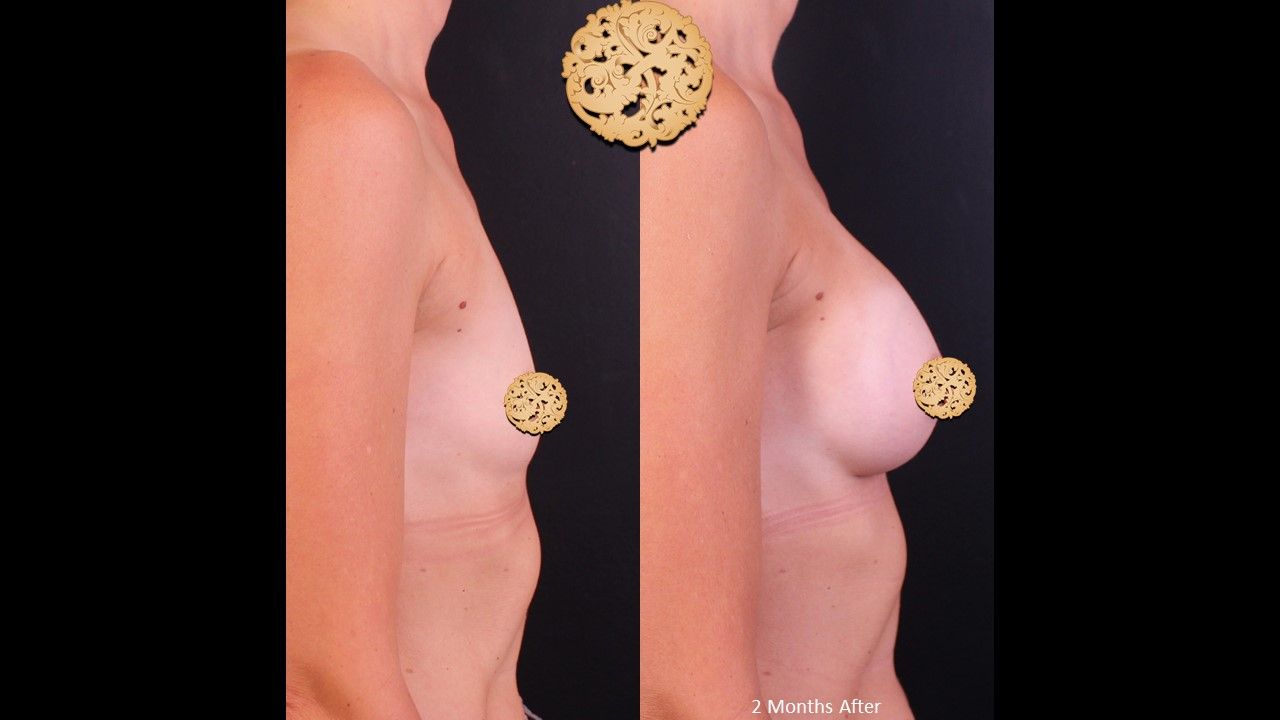 Breast Augmentation Before & After