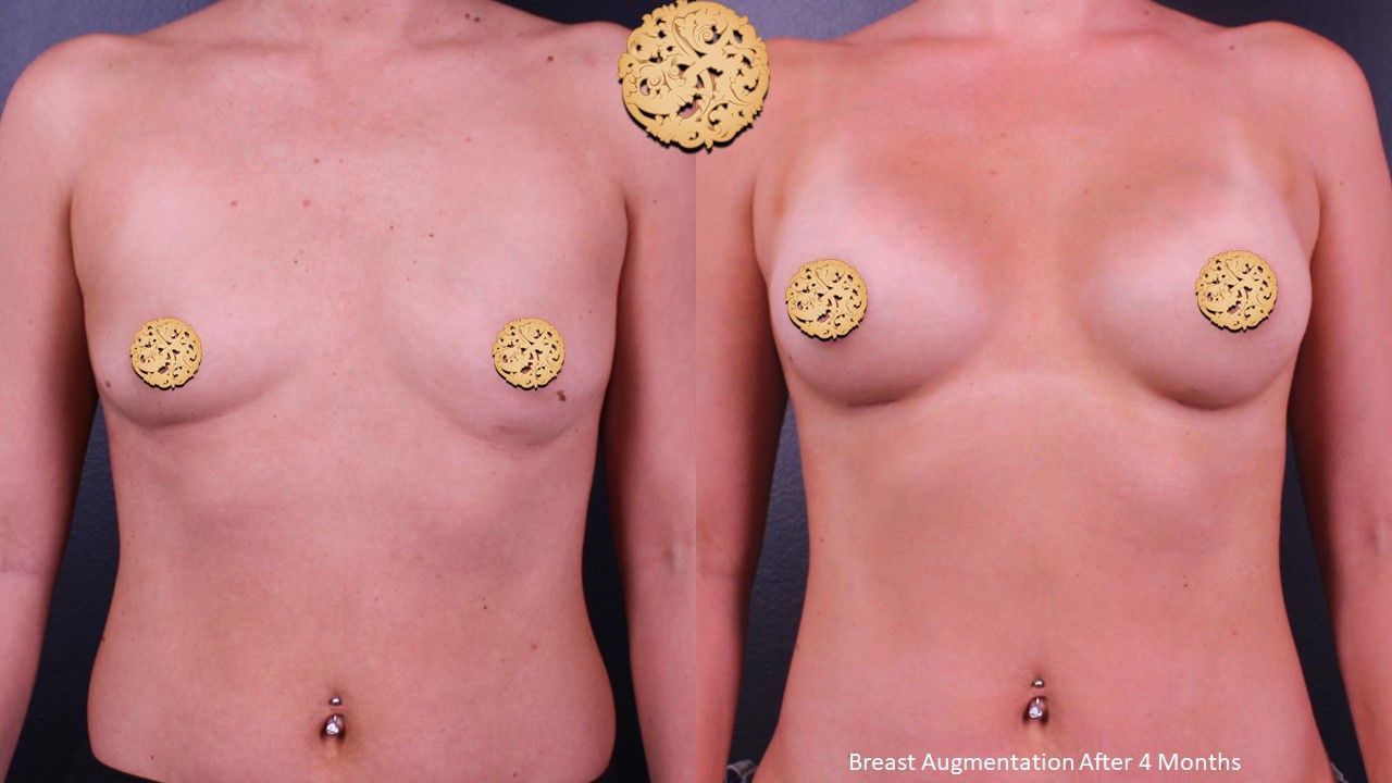 Breast Augmentation Before & After