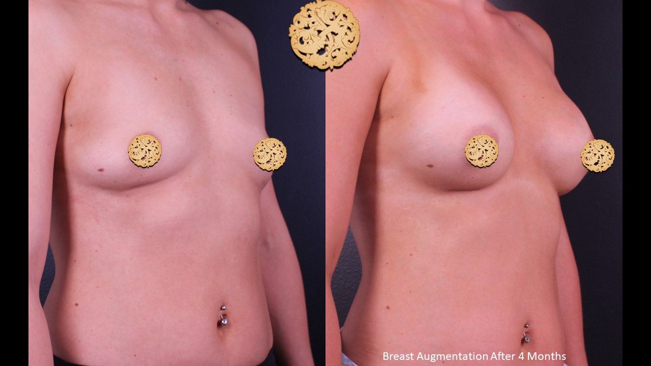 Breast Augmentation Before & After