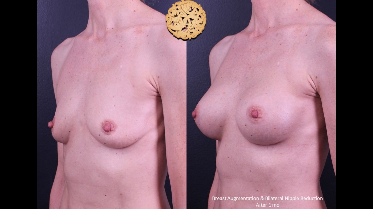 Breast Augmentation Before & After