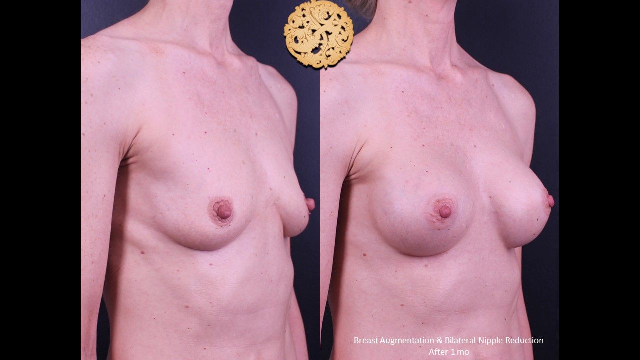 Breast Augmentation Before & After