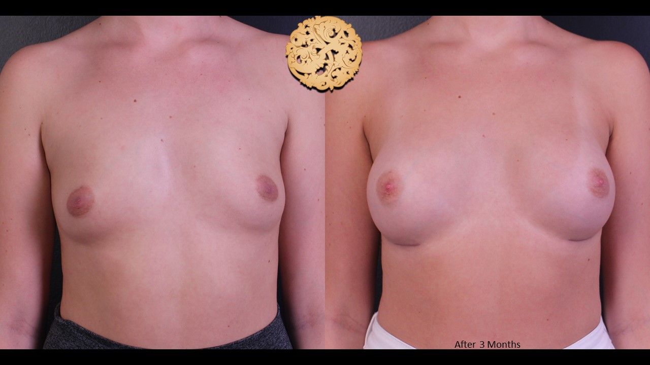 Breast Augmentation Before & After