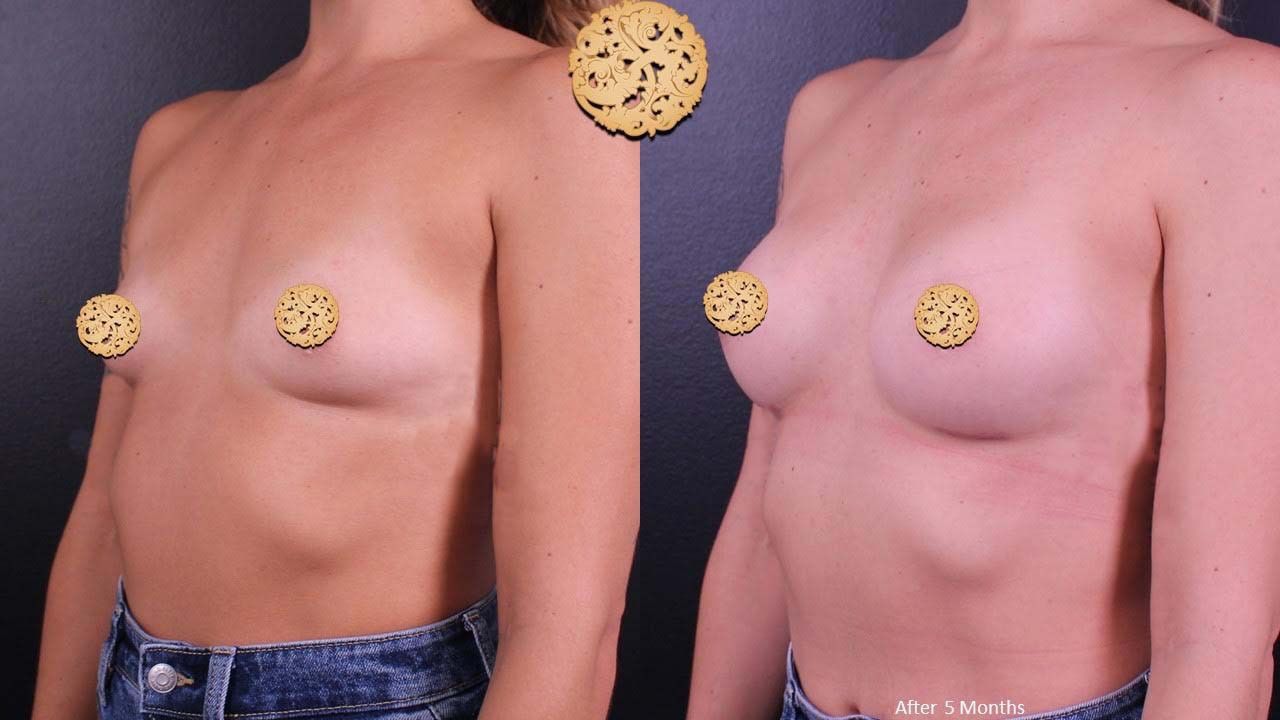 Breast Augmentation Before & After
