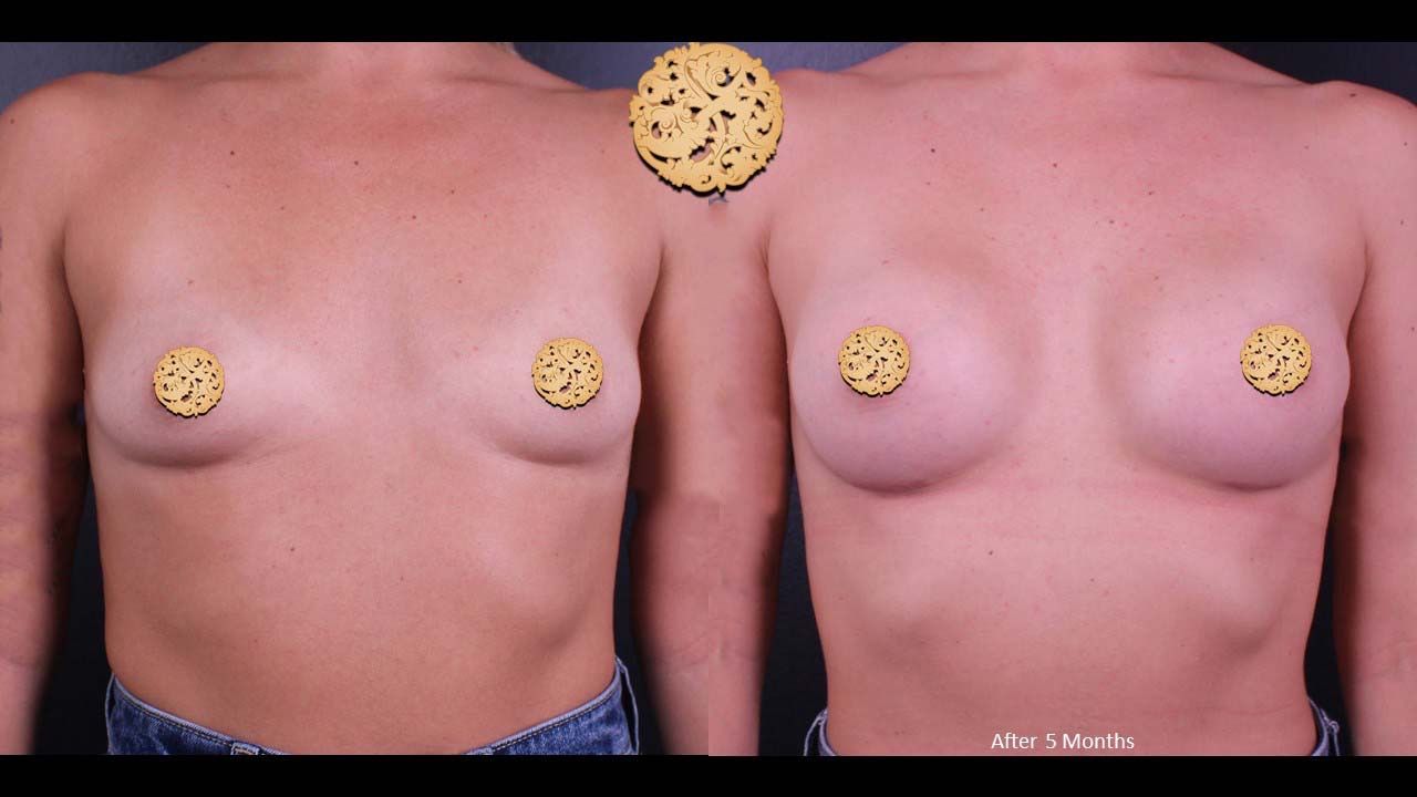 Breast Augmentation Before & After