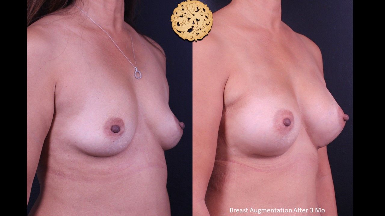Breast Augmentation Before & After