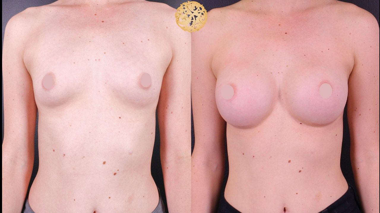 Breast Augmentation Before & After