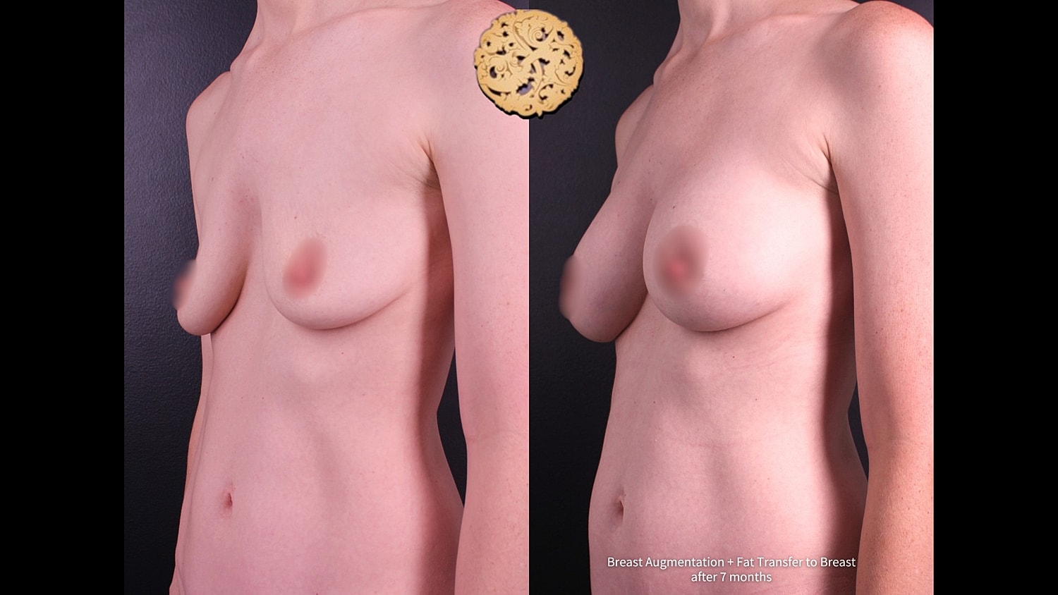 Breast augmentation before and after comparison photo.