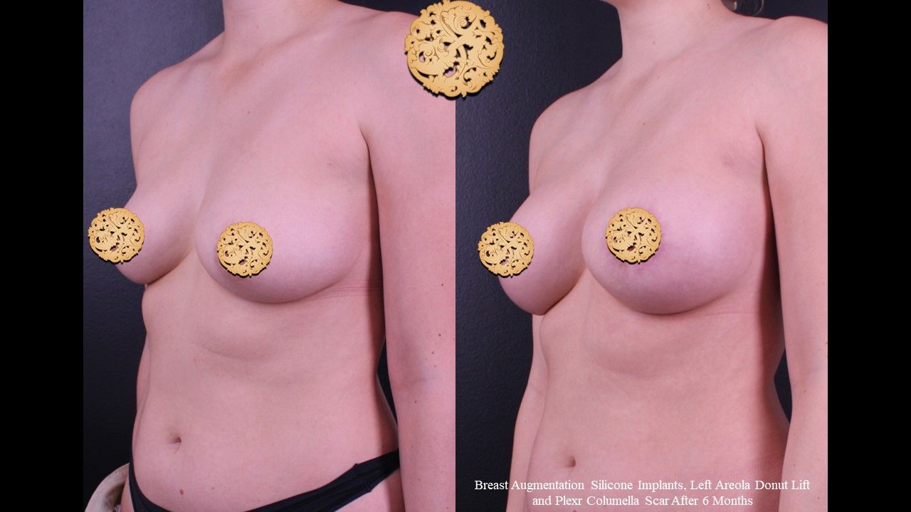 Breast Augmentation Before & After