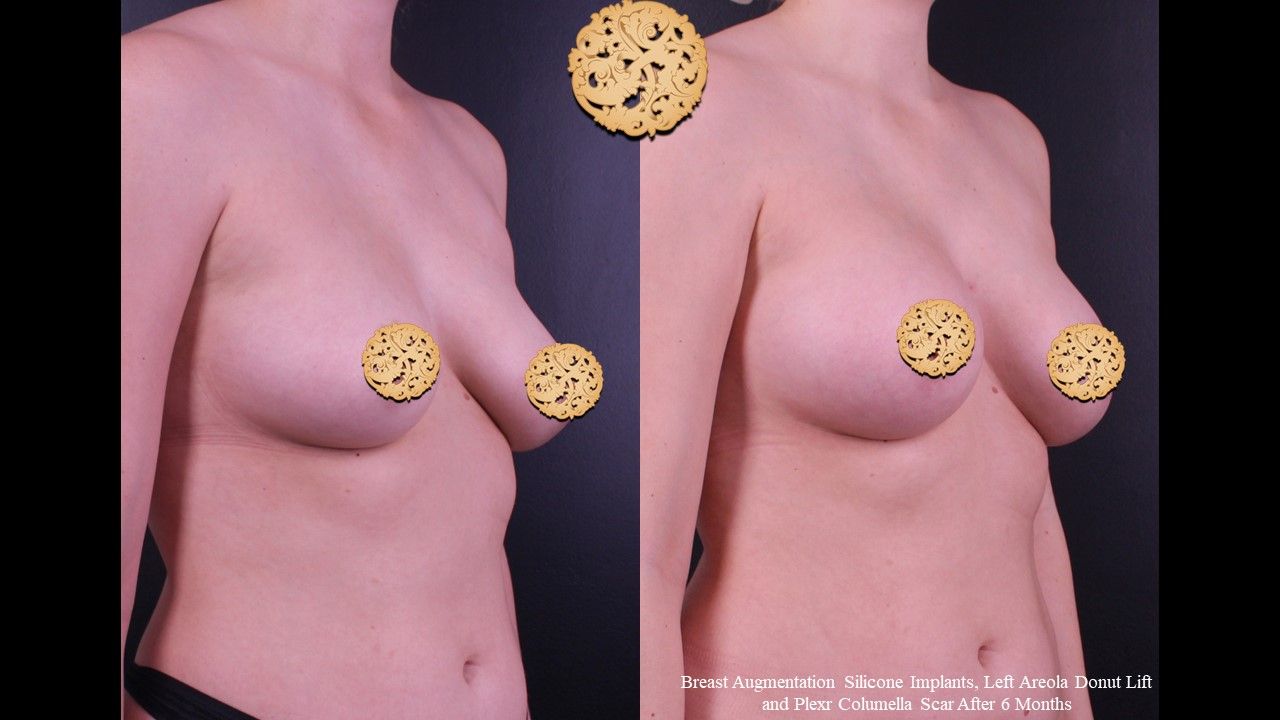Breast Augmentation Before & After