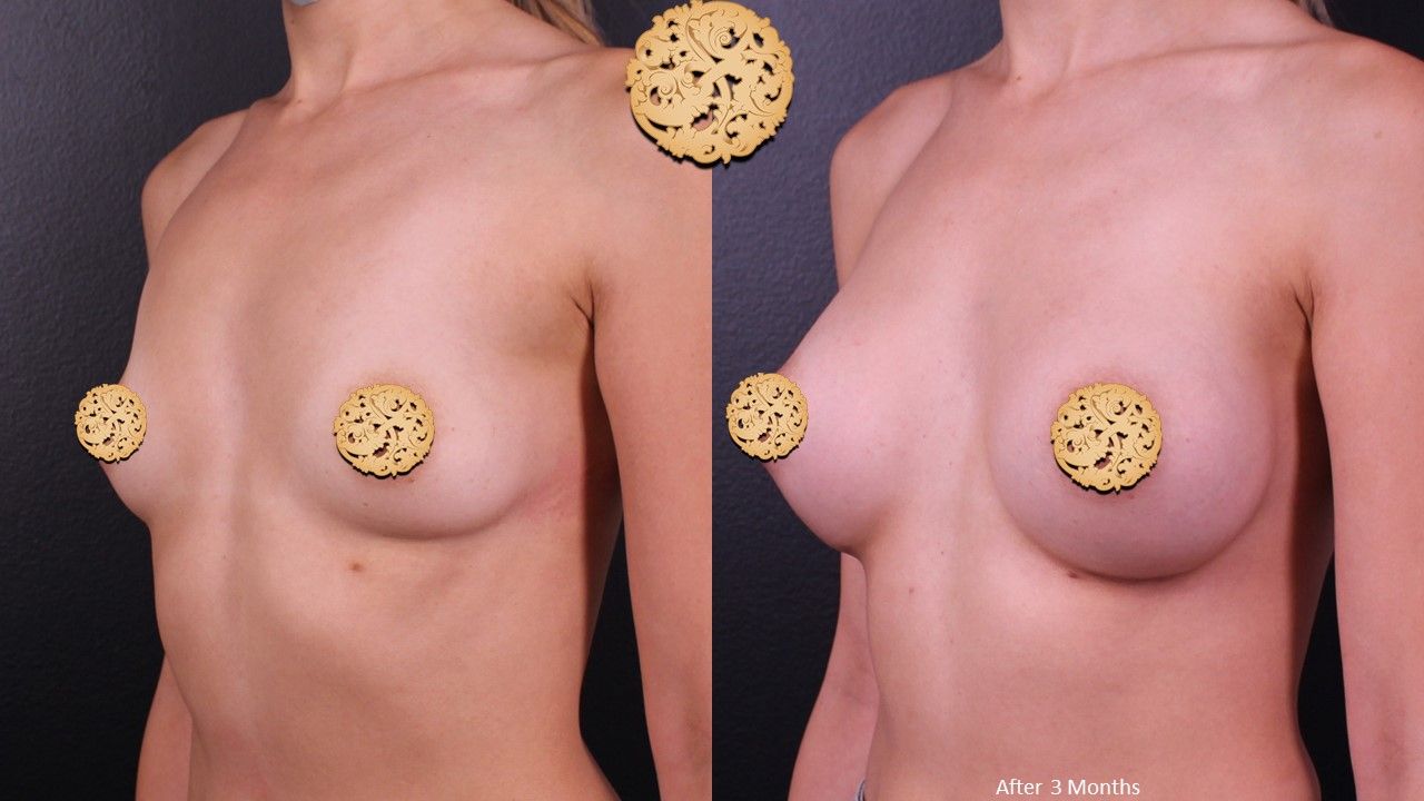 Breast Augmentation Before & After