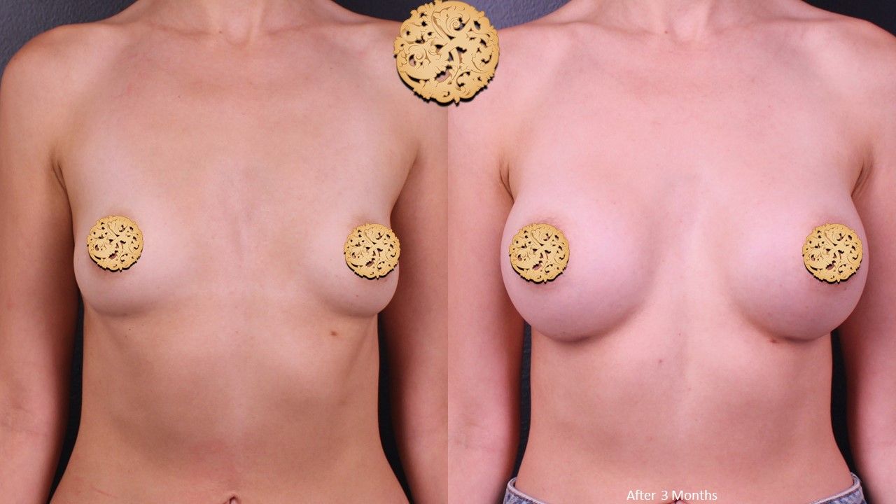 Breast Augmentation Before & After