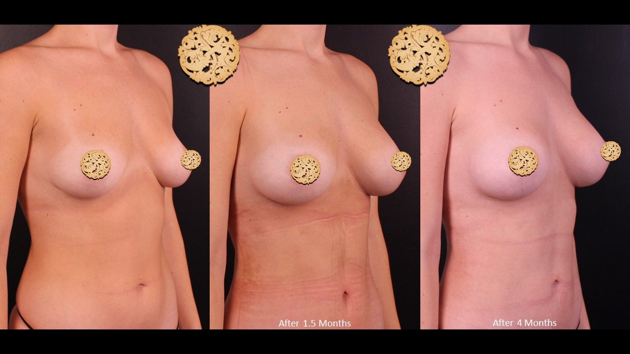 Breast Augmentation Before & After