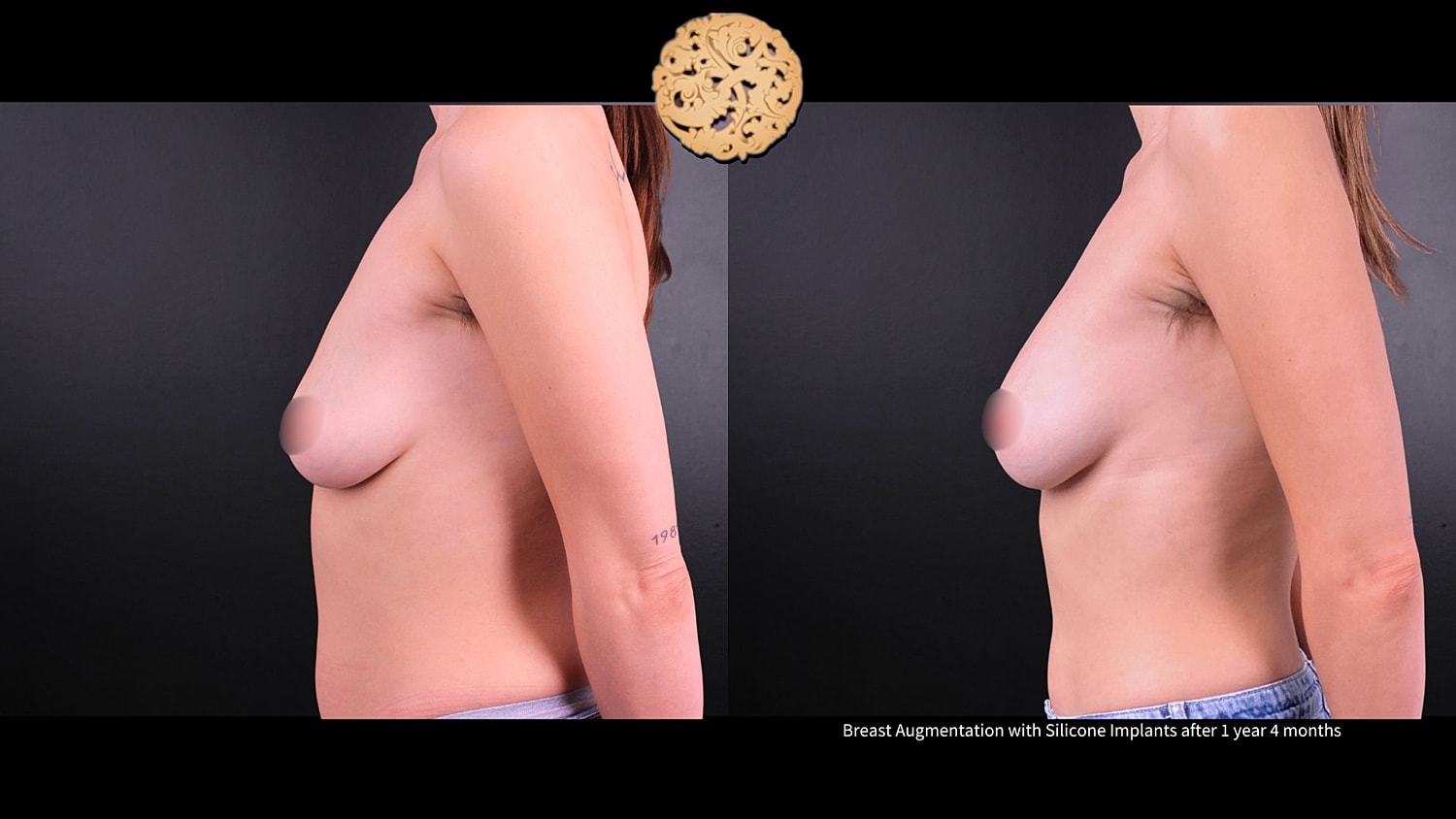 Breast Augmentation Before & After