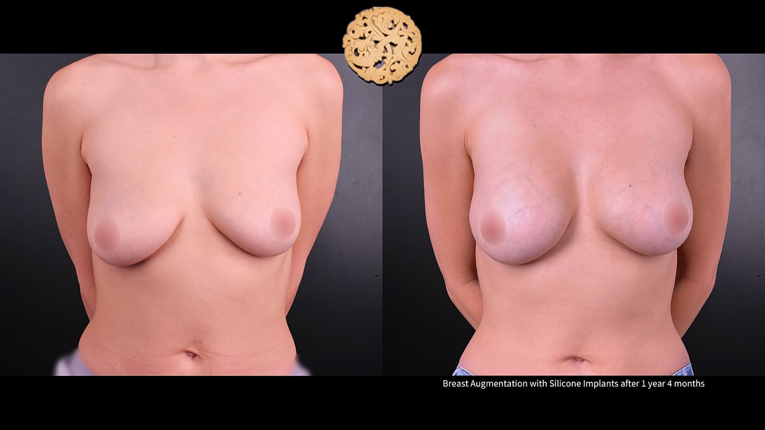 Breast Augmentation Before & After