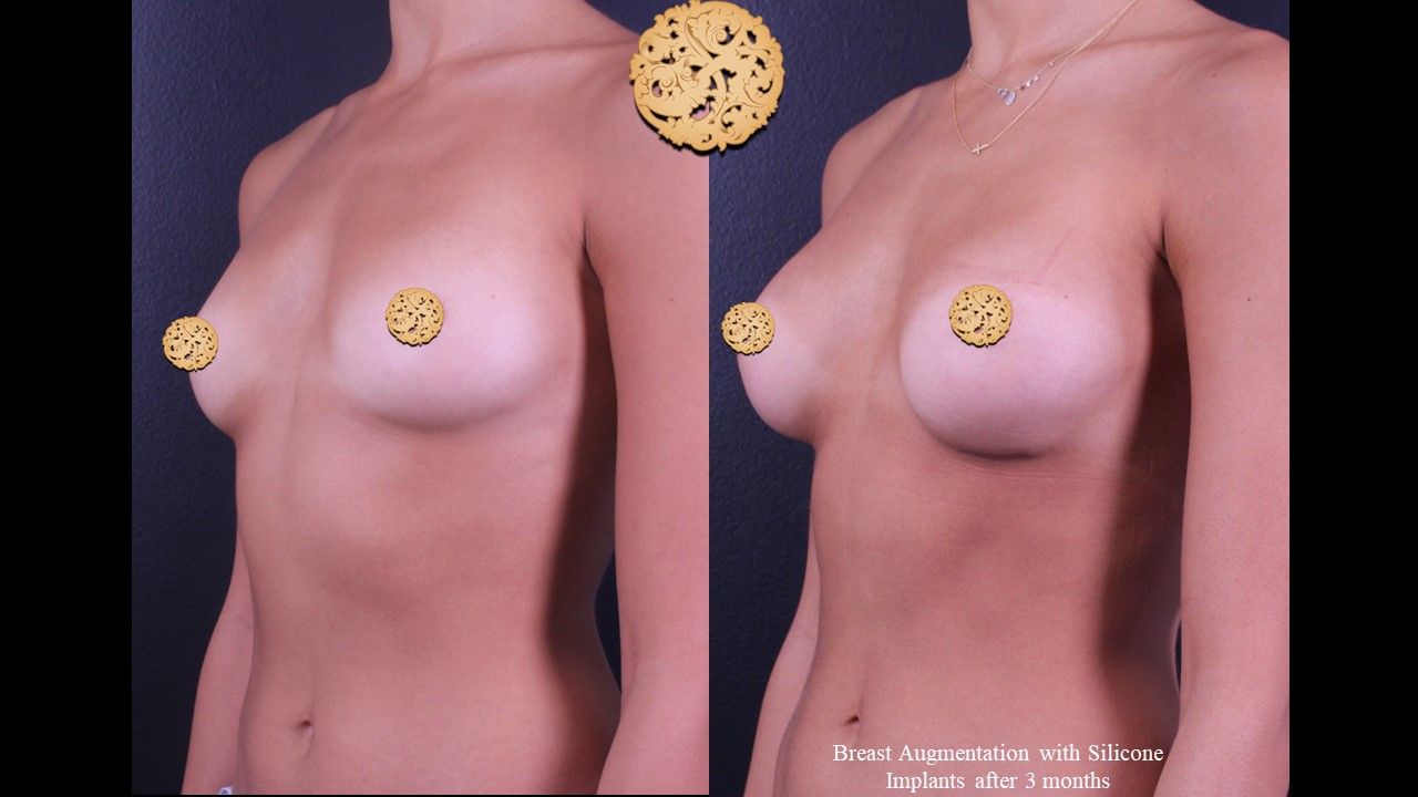 Breast Augmentation Before & After