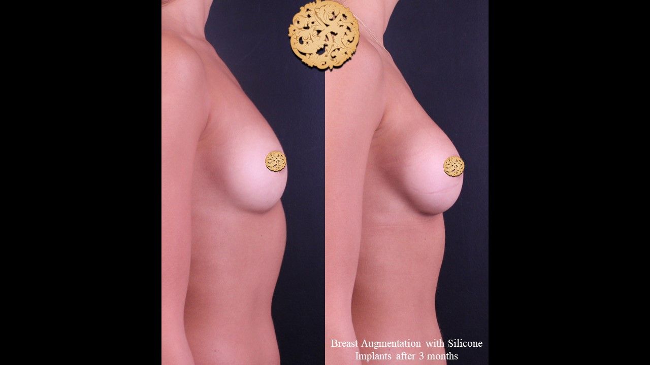 Breast Augmentation Before & After