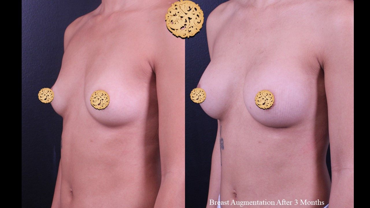 Breast Augmentation Before & After