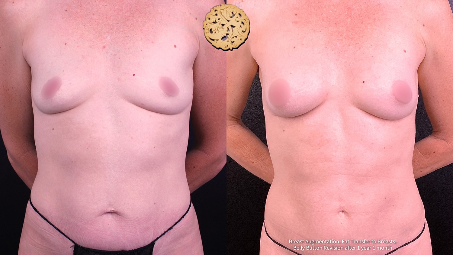 Breast Augmentation Before & After