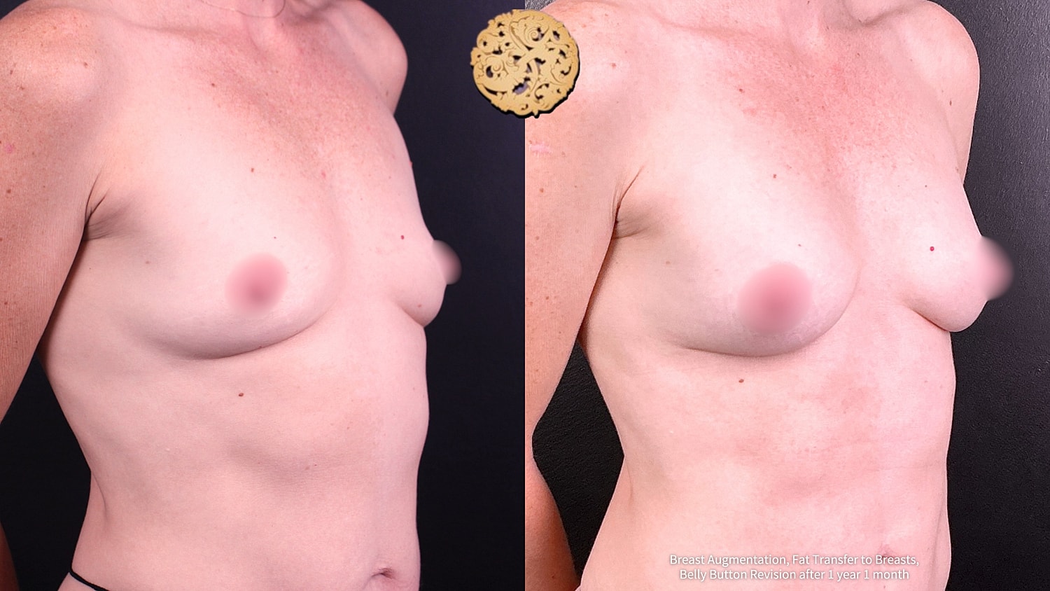 Breast Augmentation Before & After