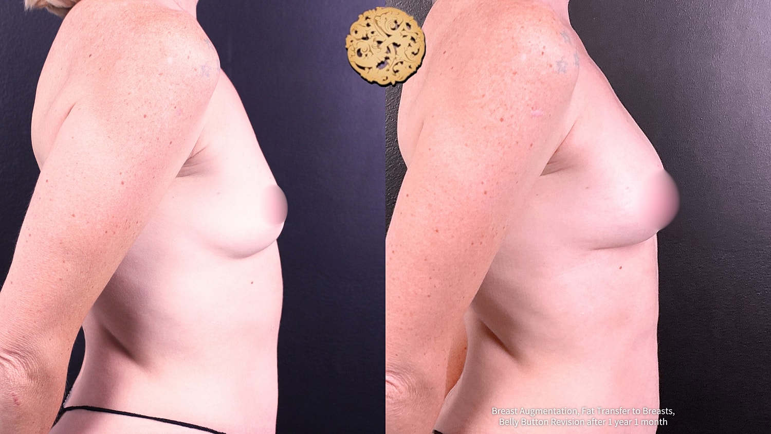 Breast Augmentation Before & After