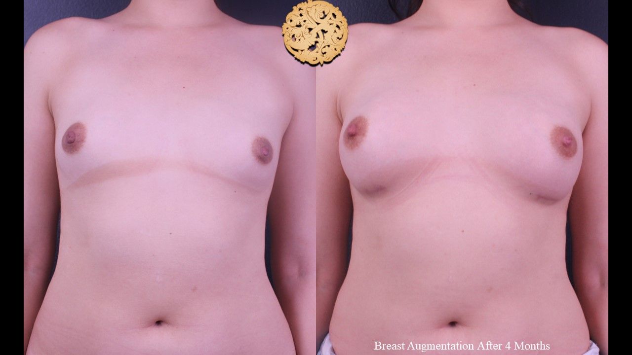 Breast Augmentation Before & After