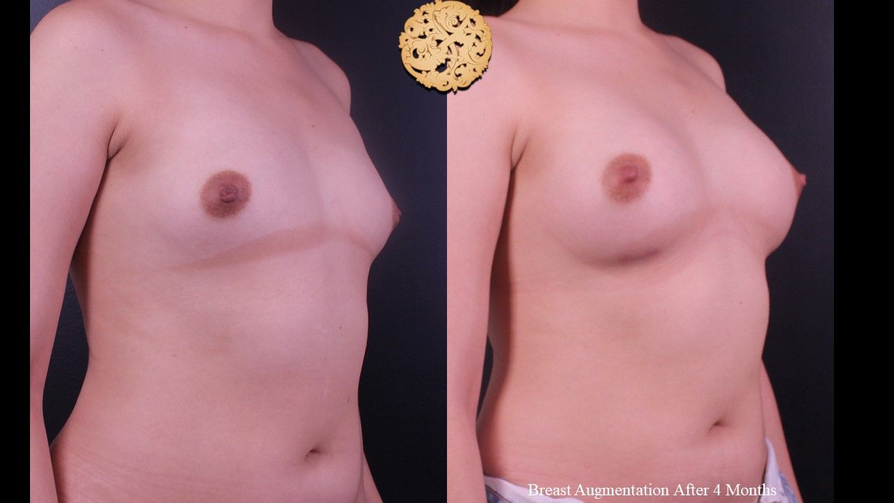Breast Augmentation Before & After