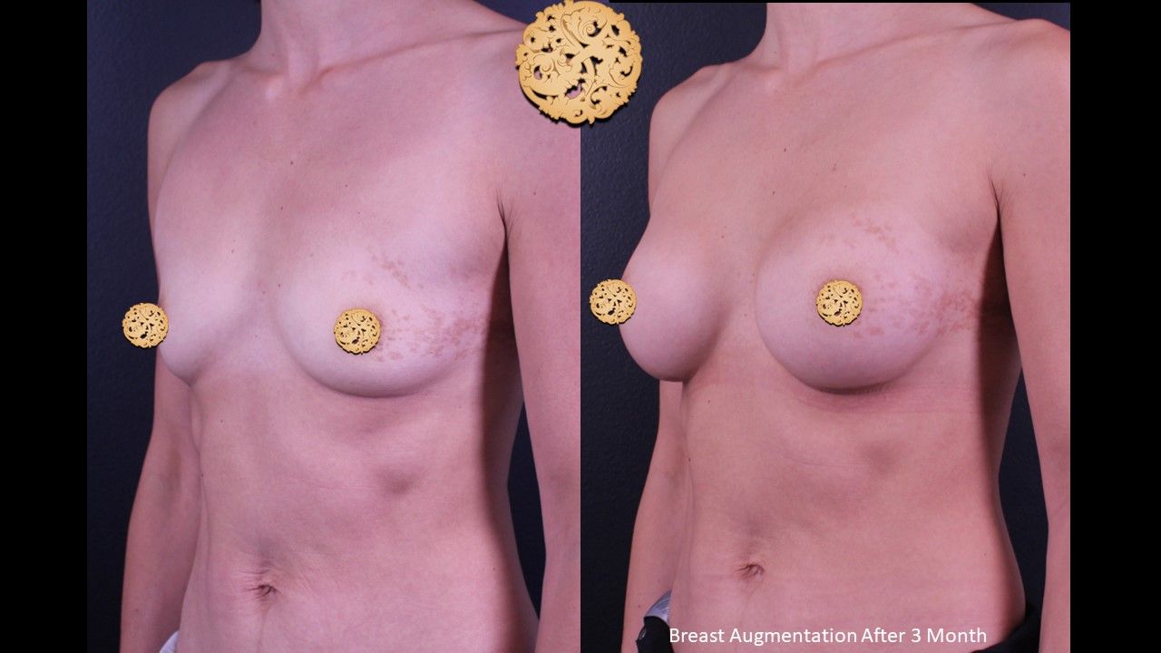 Breast Augmentation Before & After
