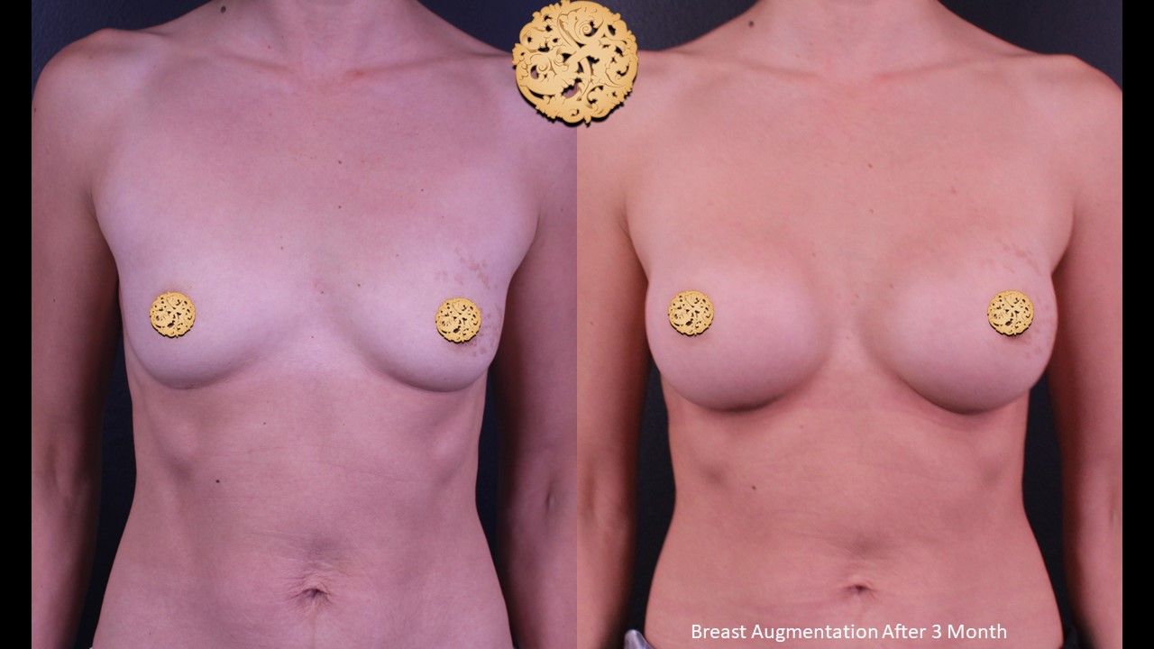 Breast Augmentation Before & After