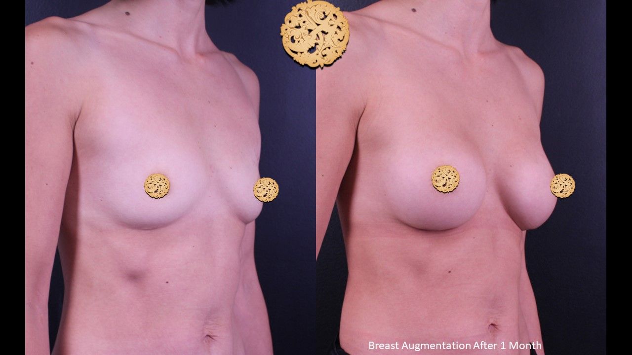 Breast Augmentation Before & After
