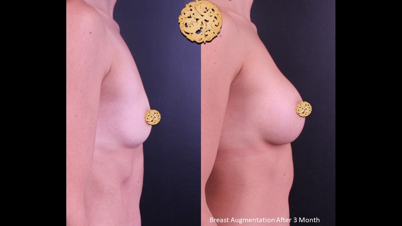 Breast Augmentation Before & After