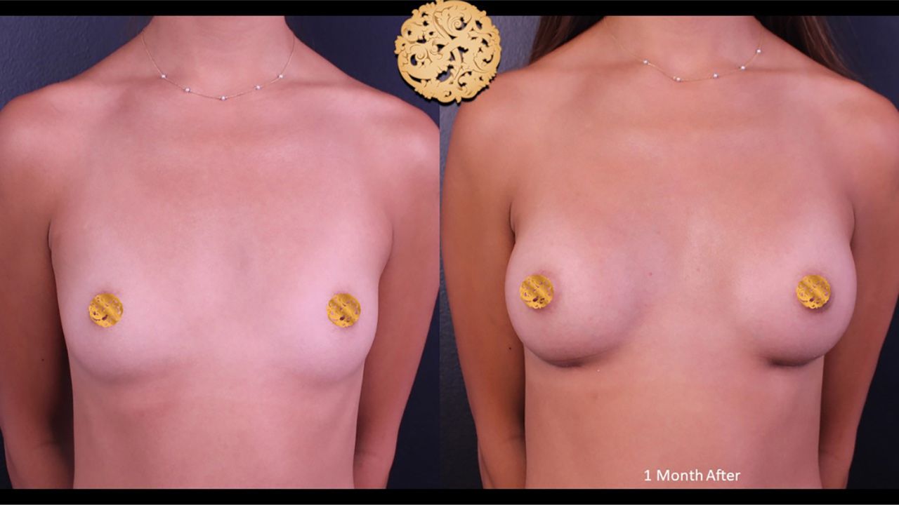 Breast Augmentation Before & After