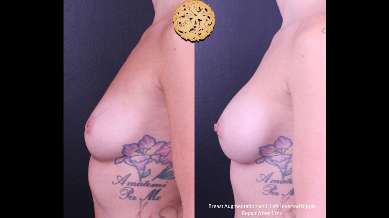 Breast Augmentation Before & After