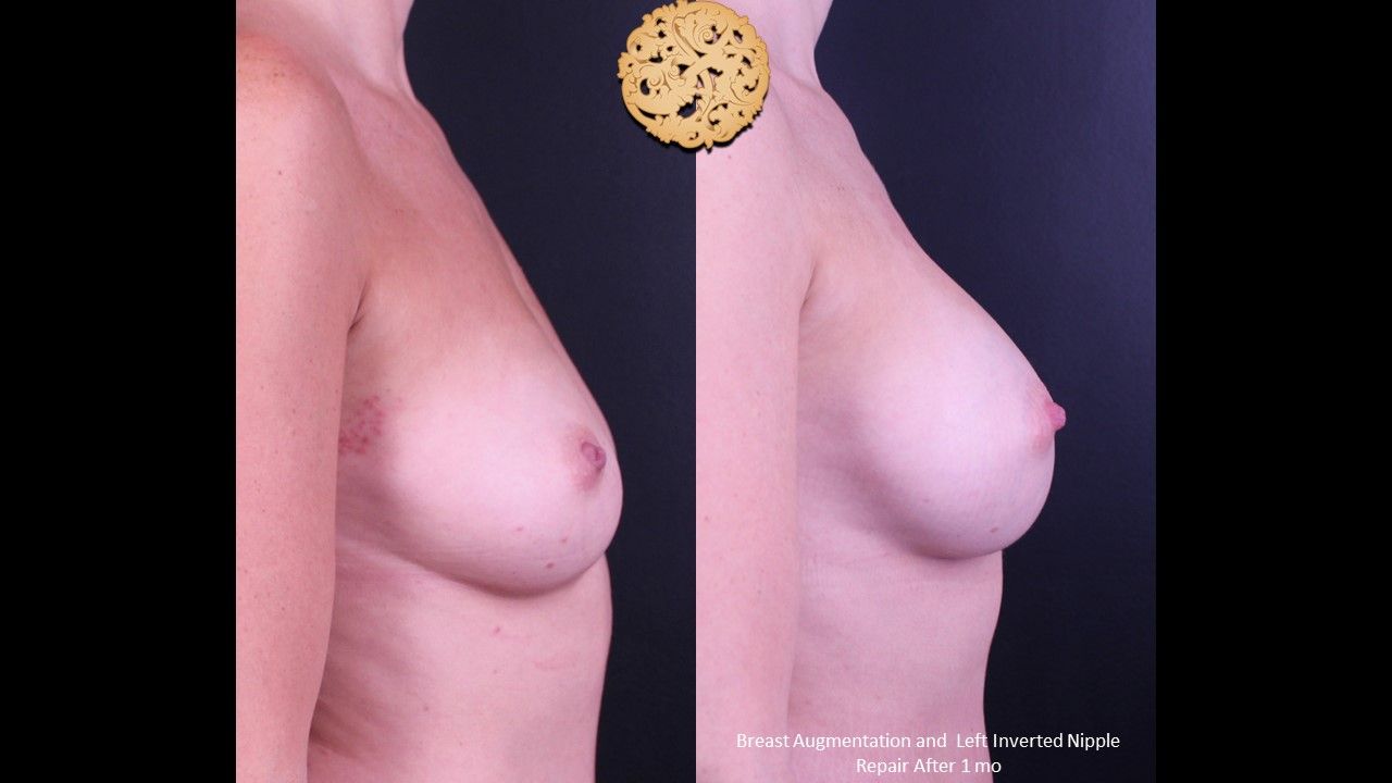 Breast Augmentation Before & After