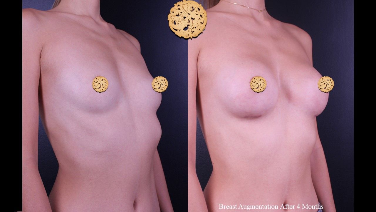Breast Augmentation Before & After
