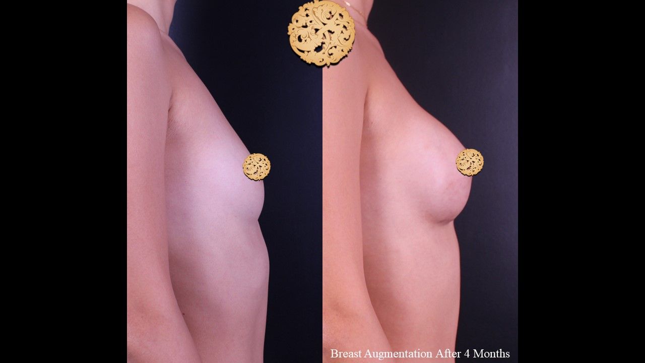 Breast Augmentation Before & After