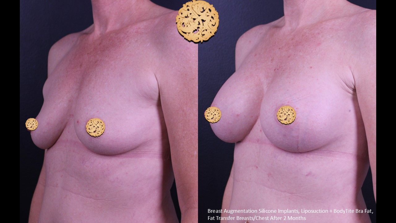 Breast Augmentation Before & After