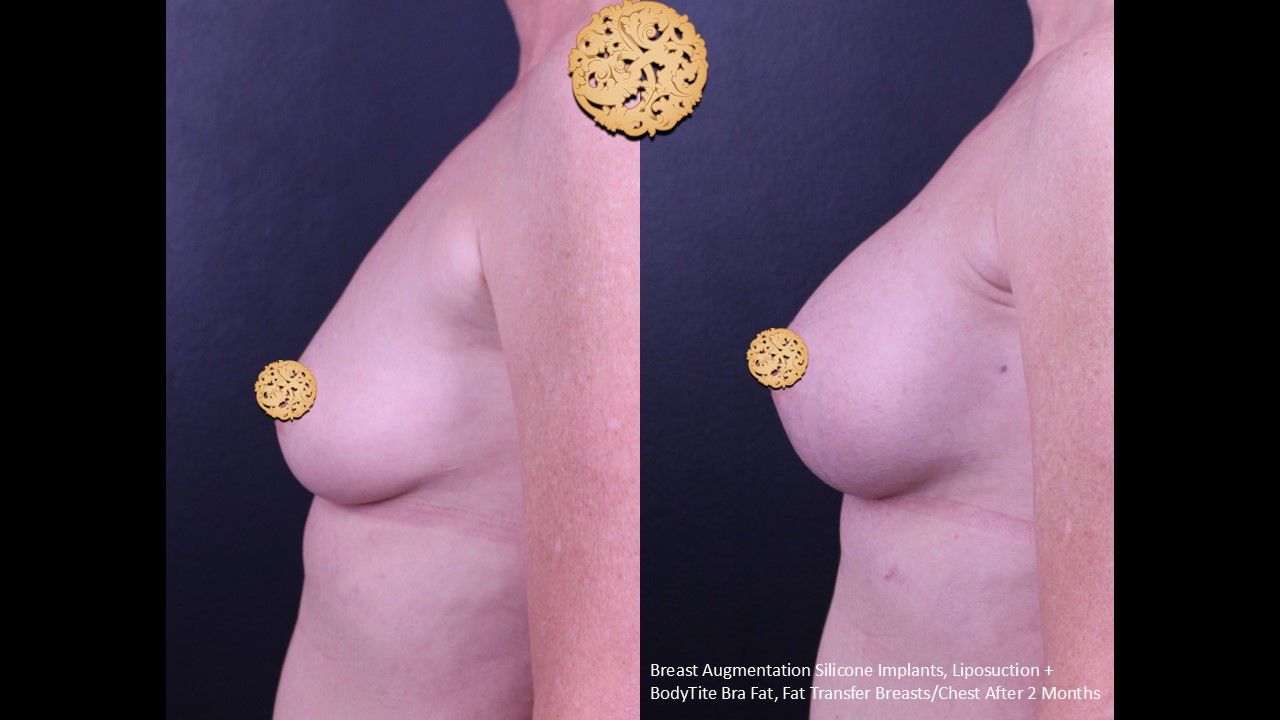 Breast Augmentation Before & After