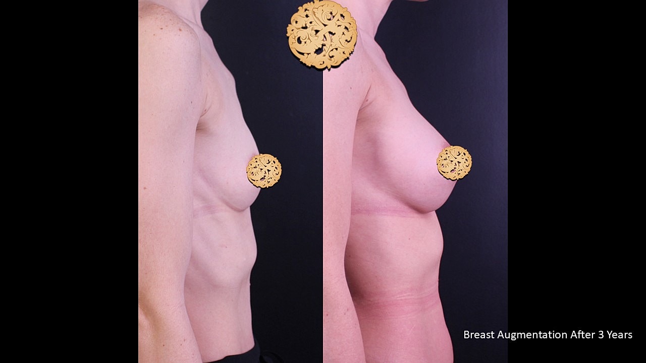 Breast Augmentation Before & After
