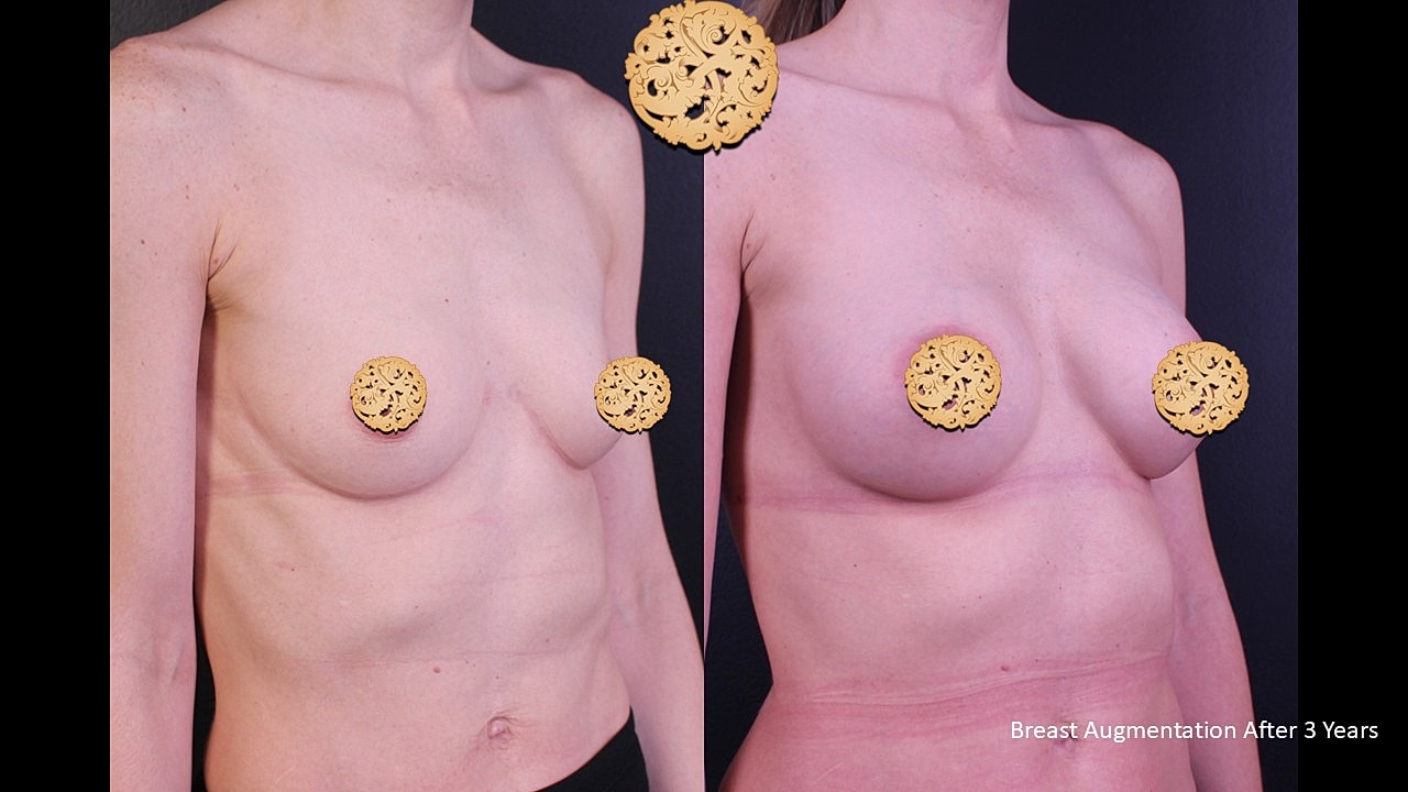 Breast Augmentation Before & After