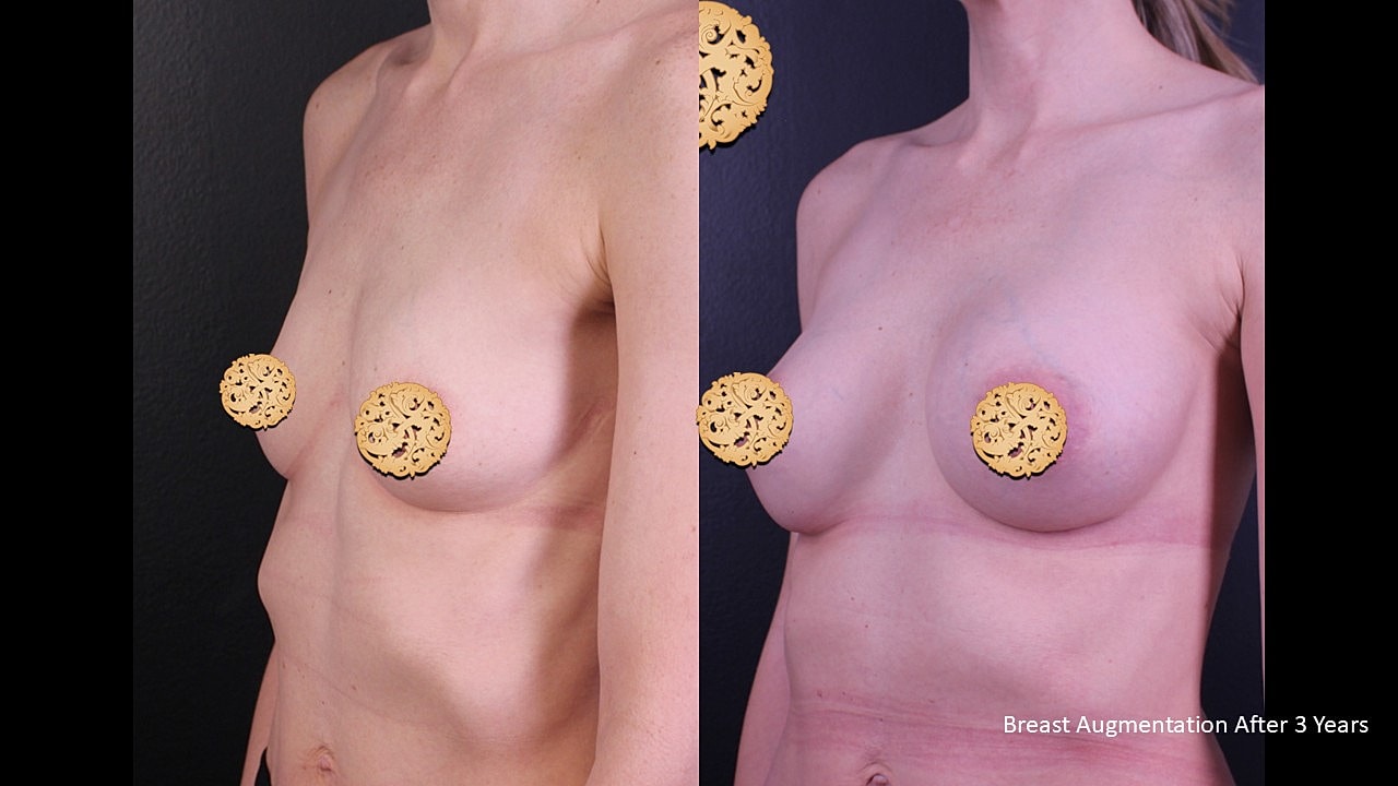 Breast Augmentation Before & After