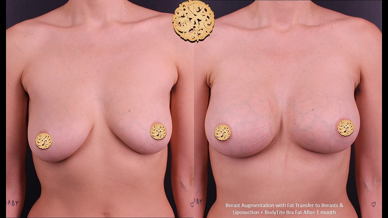 Breast Augmentation Before & After