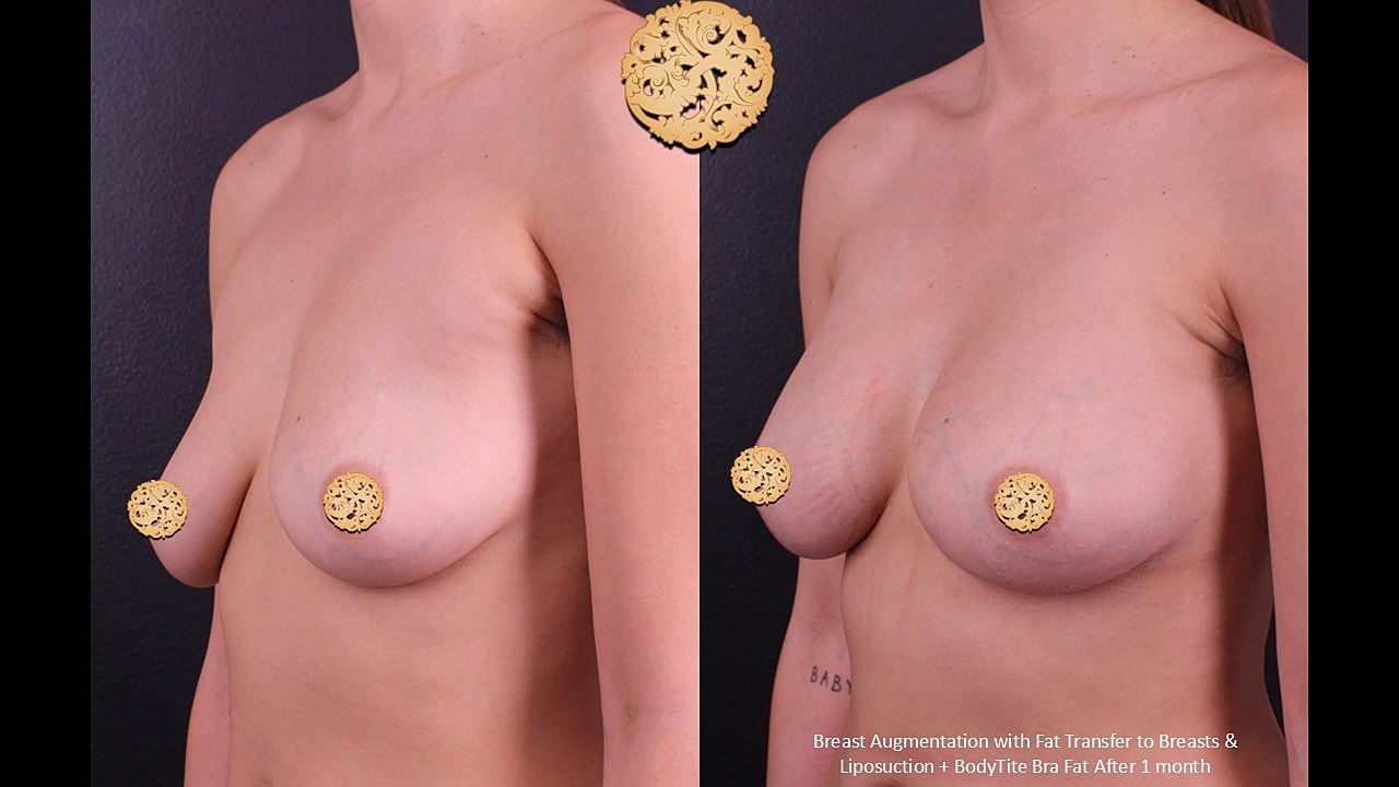 Breast Augmentation Before & After