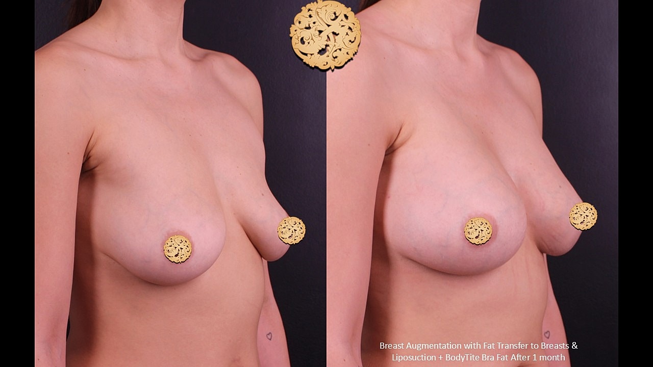 Breast Augmentation Before & After