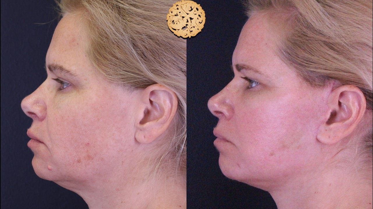 Microlaser Peel Before & After