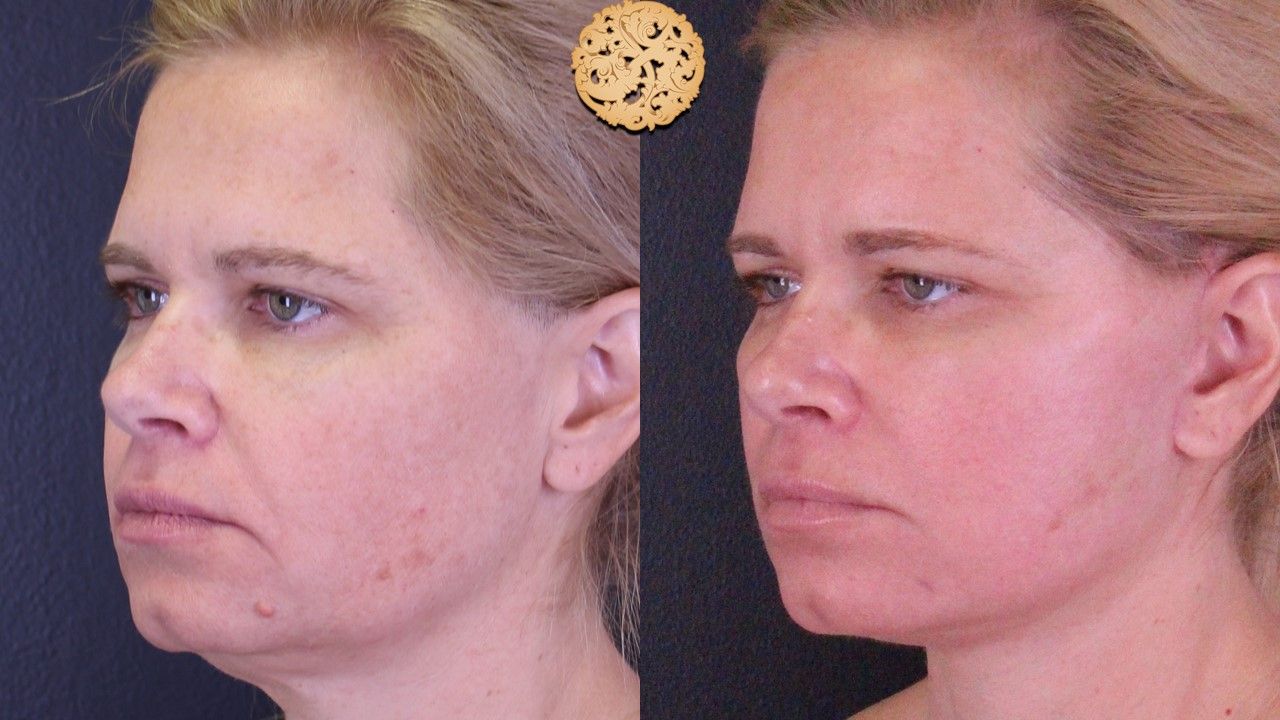 Microlaser Peel Before & After