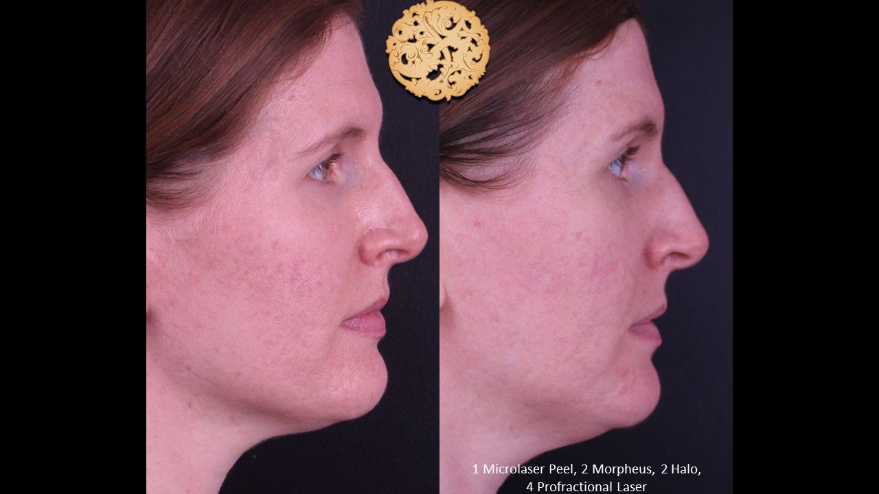Microlaser Peel Before & After