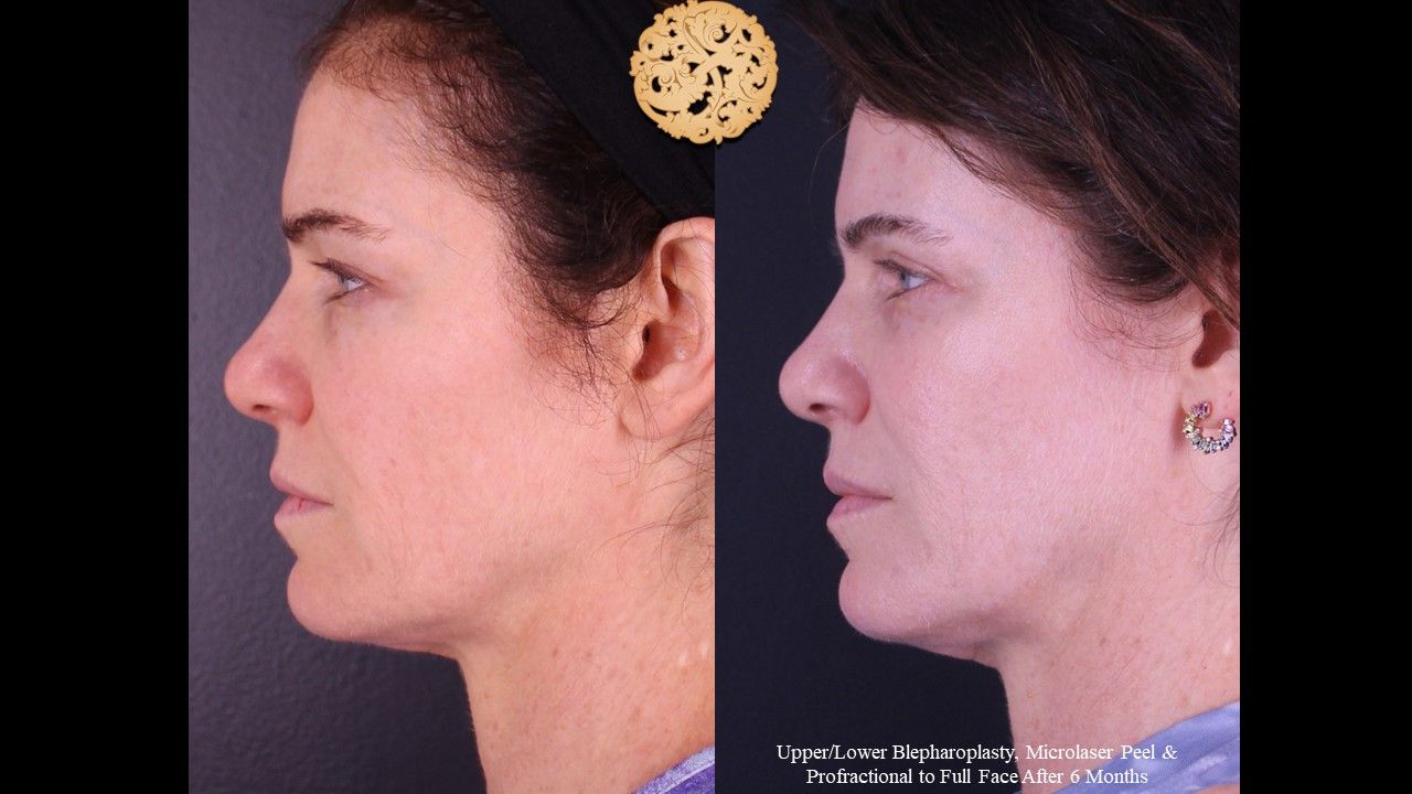 Microlaser Peel Before & After