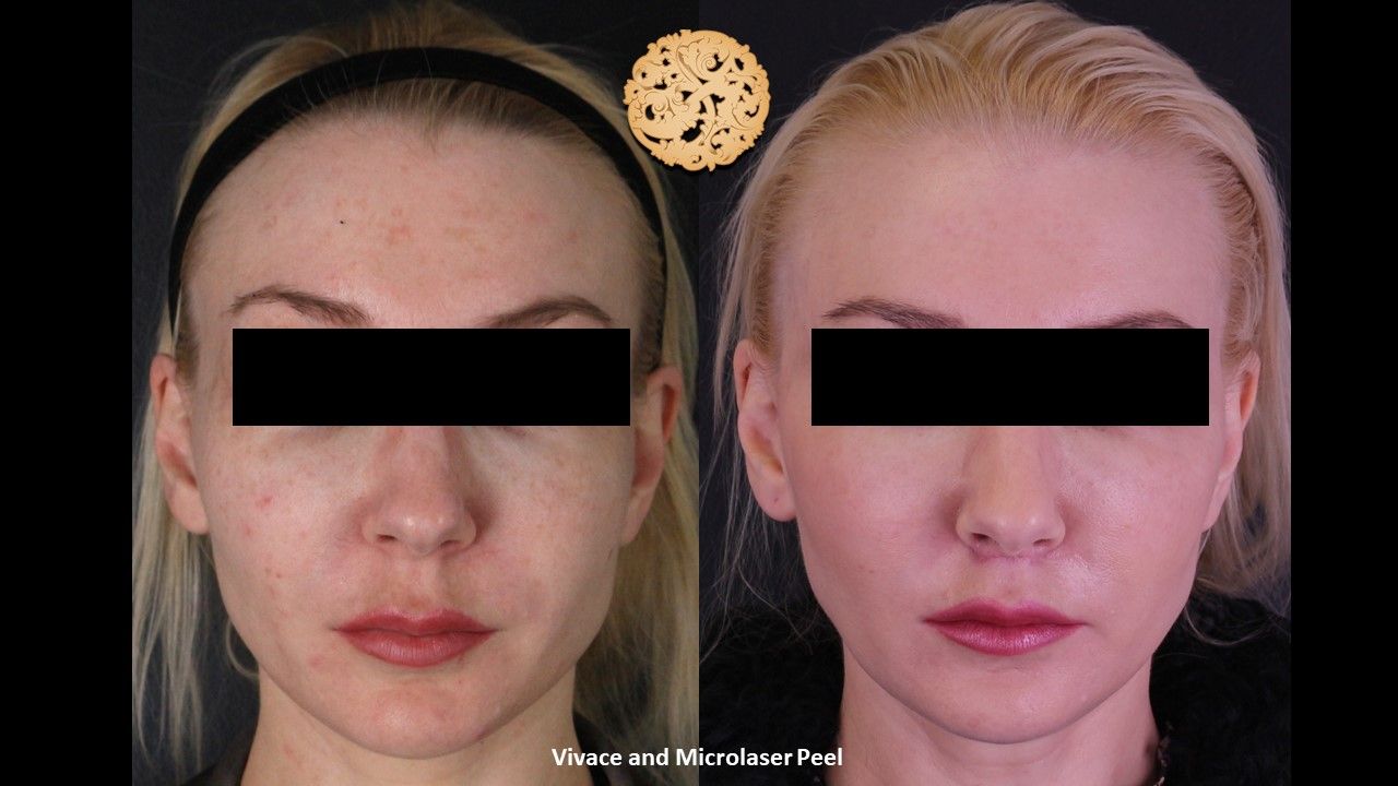 Microlaser Peel Before & After