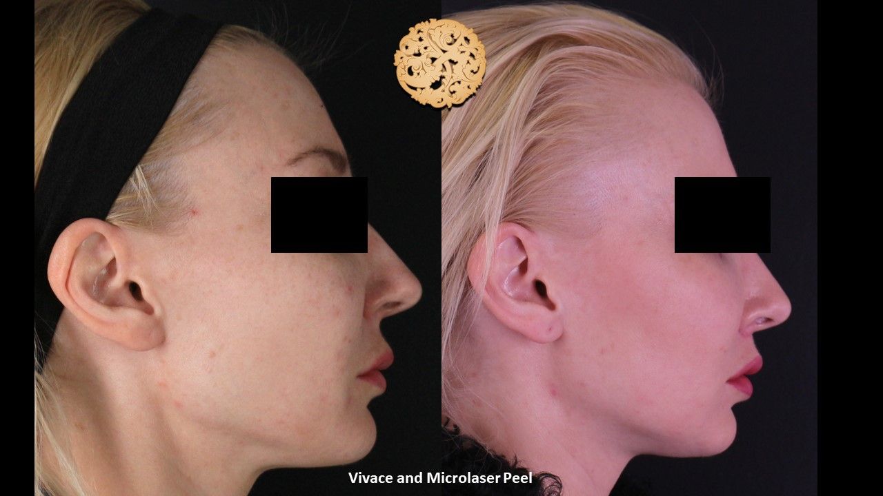 Microlaser Peel Before & After